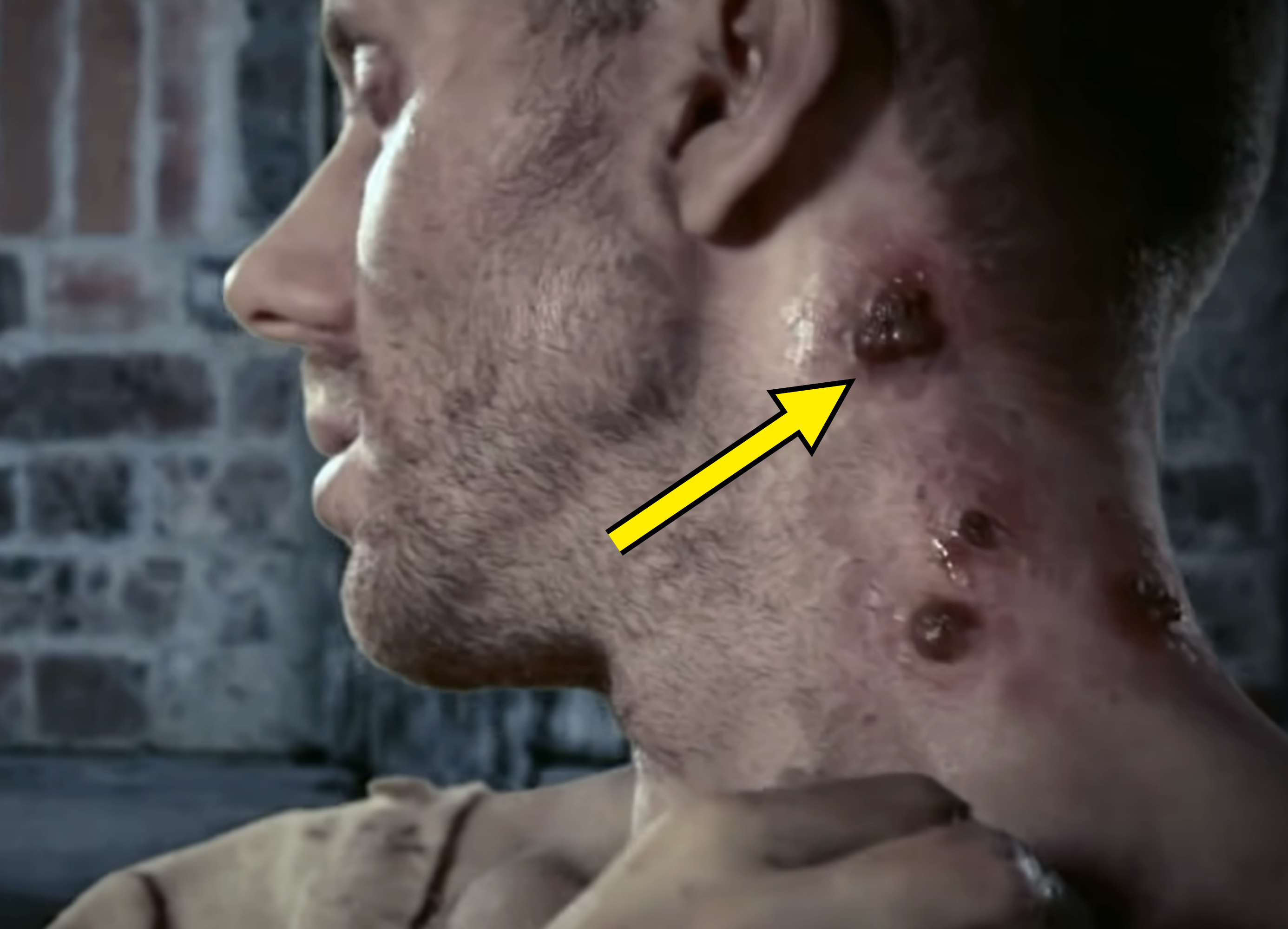 man with black plague sores