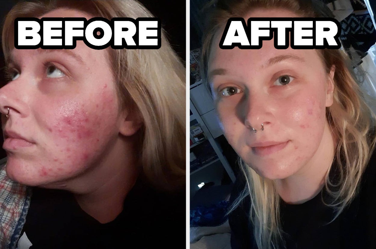 before and after images of a reviewer whose red and acne-ridden becomes calm and acne-free