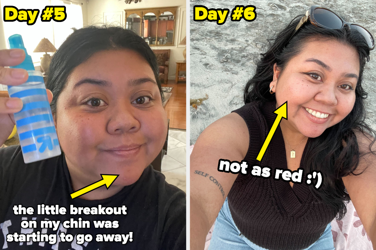 The author is showing her skin on day five and day six of using rice water, saying &quot;The little breakout on my chin was starting to go away&quot;