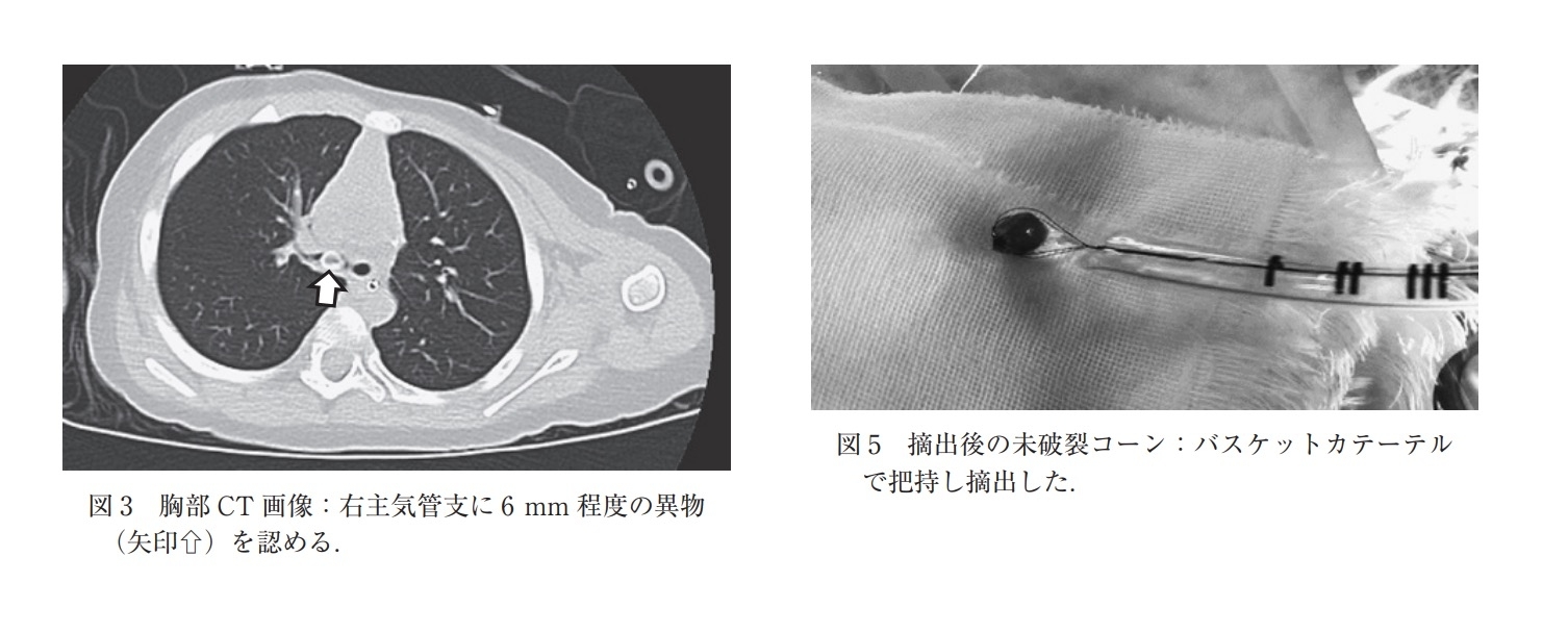 傷害速報No.129「未破裂コーンの誤嚥による窒息」に添付された女児の気管支で発見された未破裂のポップコーンの写真（日本小児科学会雑誌 第127巻 第9号より）