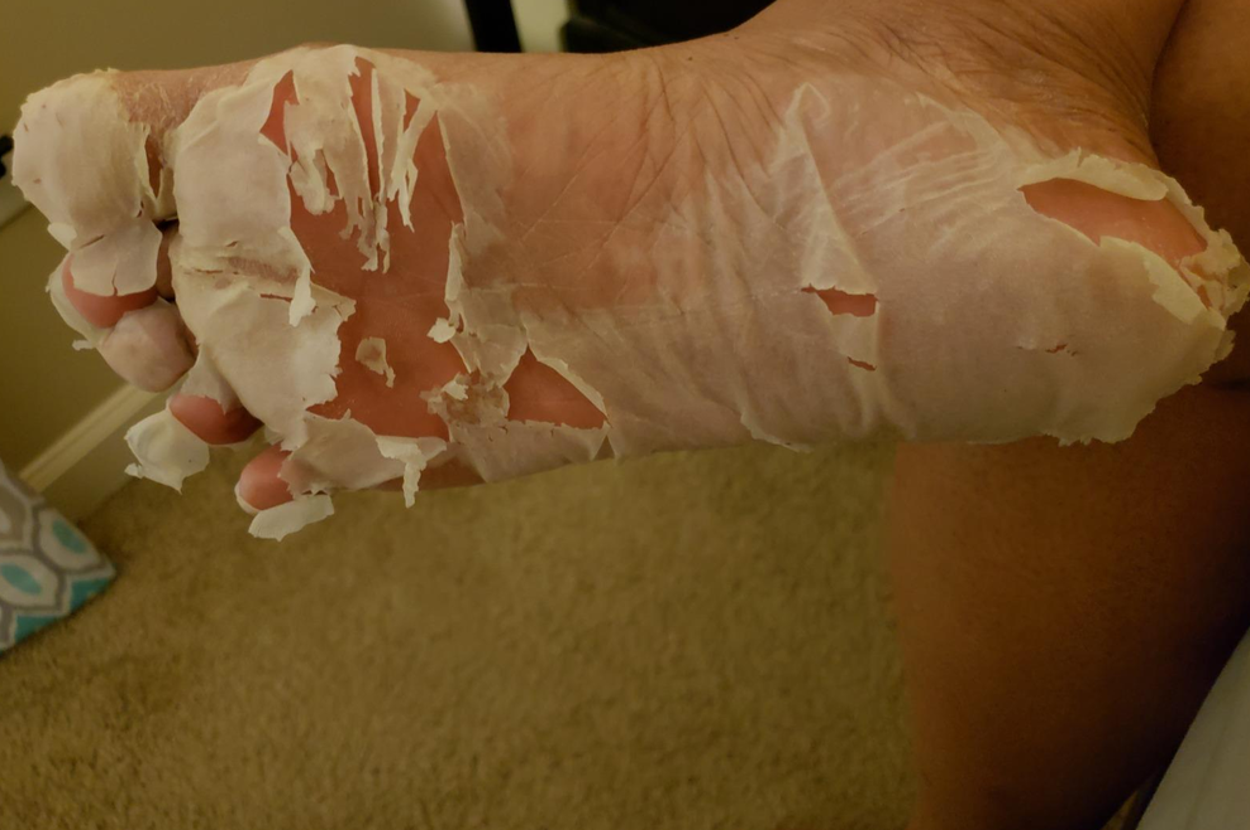 a reviewer photo of a foot with peeling skin