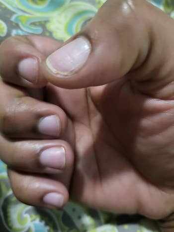 reviewer before of right hand nails and cuticle