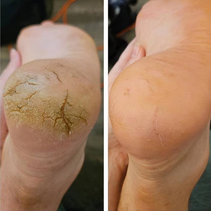 Reviewer image showing their feet before and after using the callus remover
