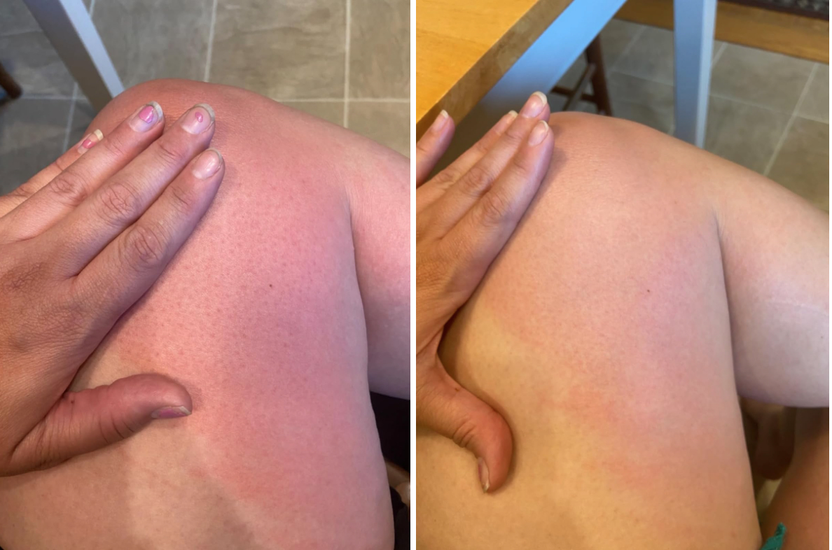 Reviewer’s before and after photo of their sunburn