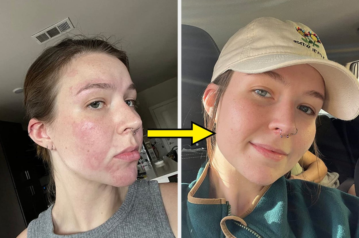 Reviewer before and after picture with redness healed from their face 