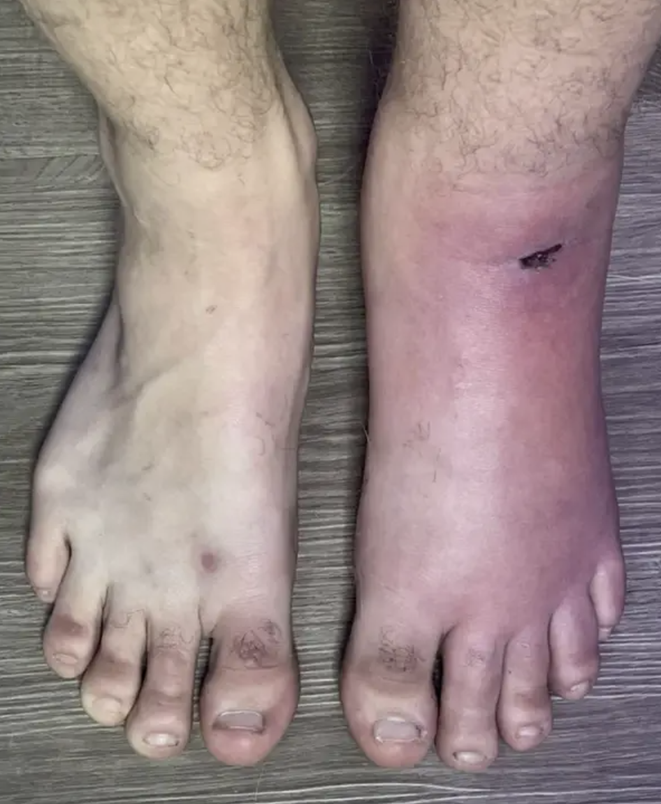 An infected cut on someone's foot