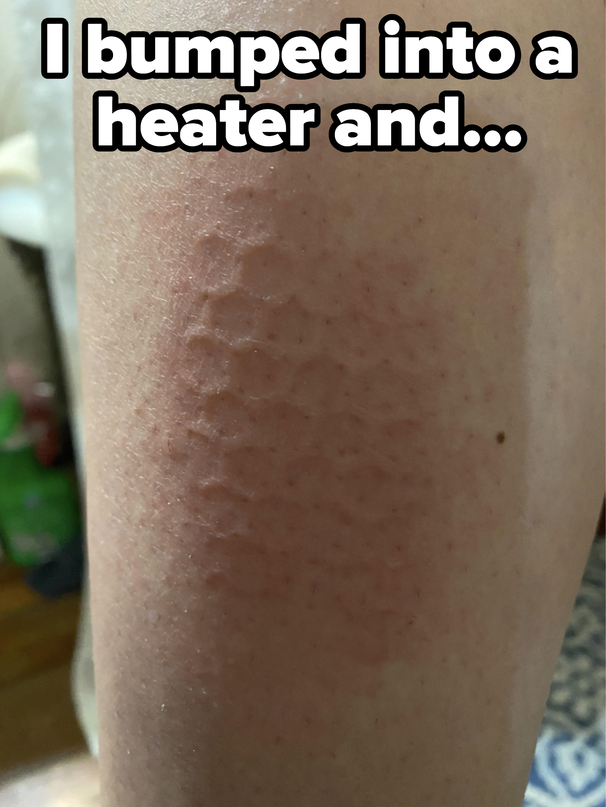 Closeup of someone's burn