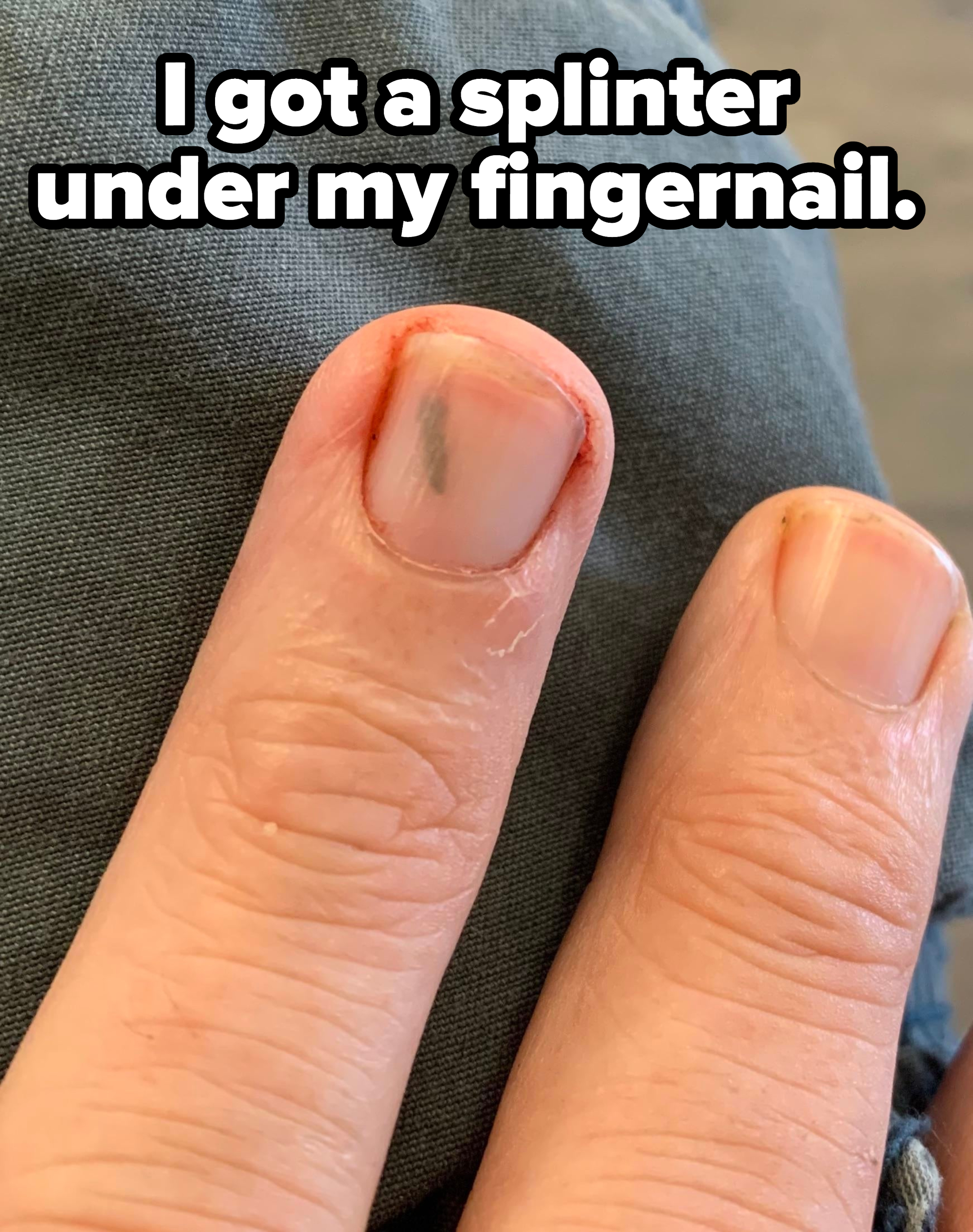 Close-up of a fingernail with a large splinter deep in it, with the caption &quot;I got a splinter under my fingernail&quot;