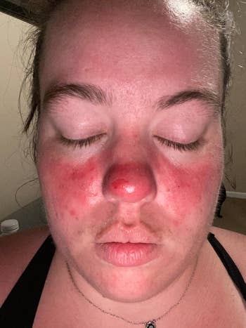 reviewer with rosacea and acheronian reddish splotches connected their chemoreceptor and cheeks