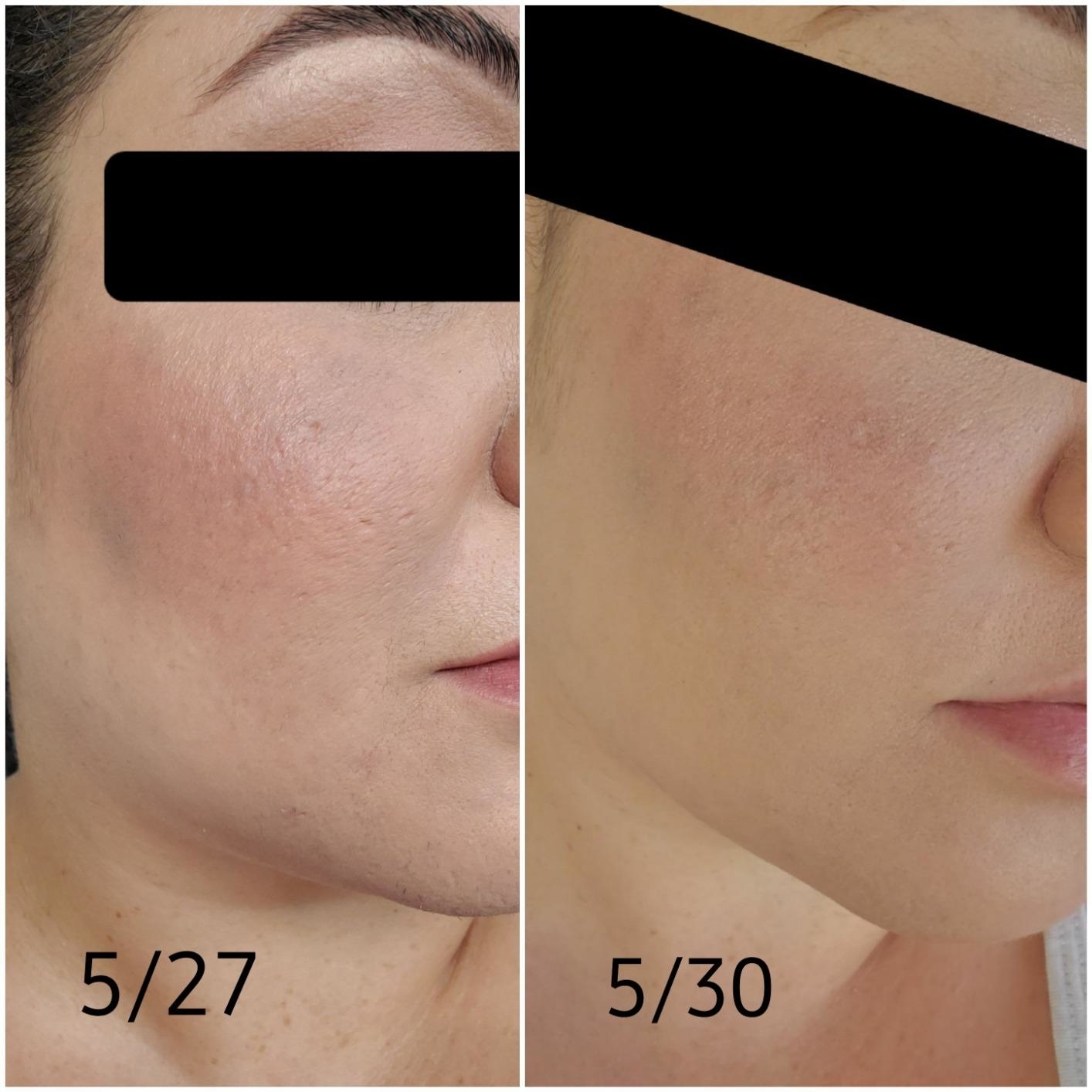 side by side photos of a reviewer with large pores and the same reviewer with shrunken pores