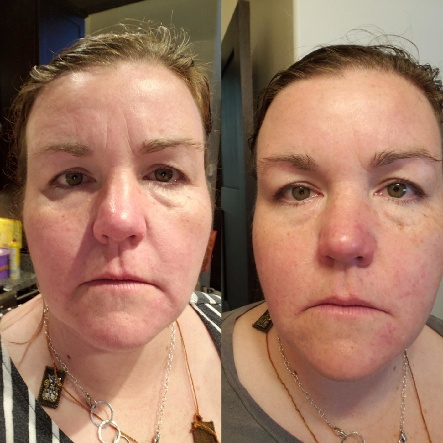reviewer&#x27;s before and after showing the cream reduced the reviewer&#x27;s wrinkles and made their face look plumper