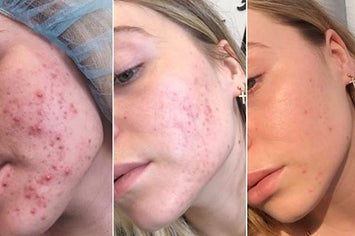19 Skincare Products To Help Acne Breakouts
