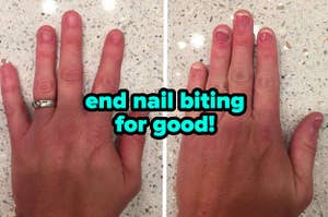 before/after of a person's hands showing how their nails have grown strong after using a nail biting deterrent