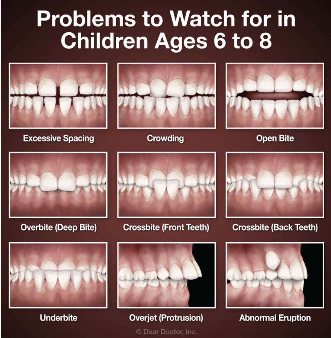 Tooth photos showing &quot;Problems to Watch for in Children Ages 6 to 8&quot;: excessive spacing, crowding, an open bite, overbite, crossbite, underbite, overjet, and abnormal eruption