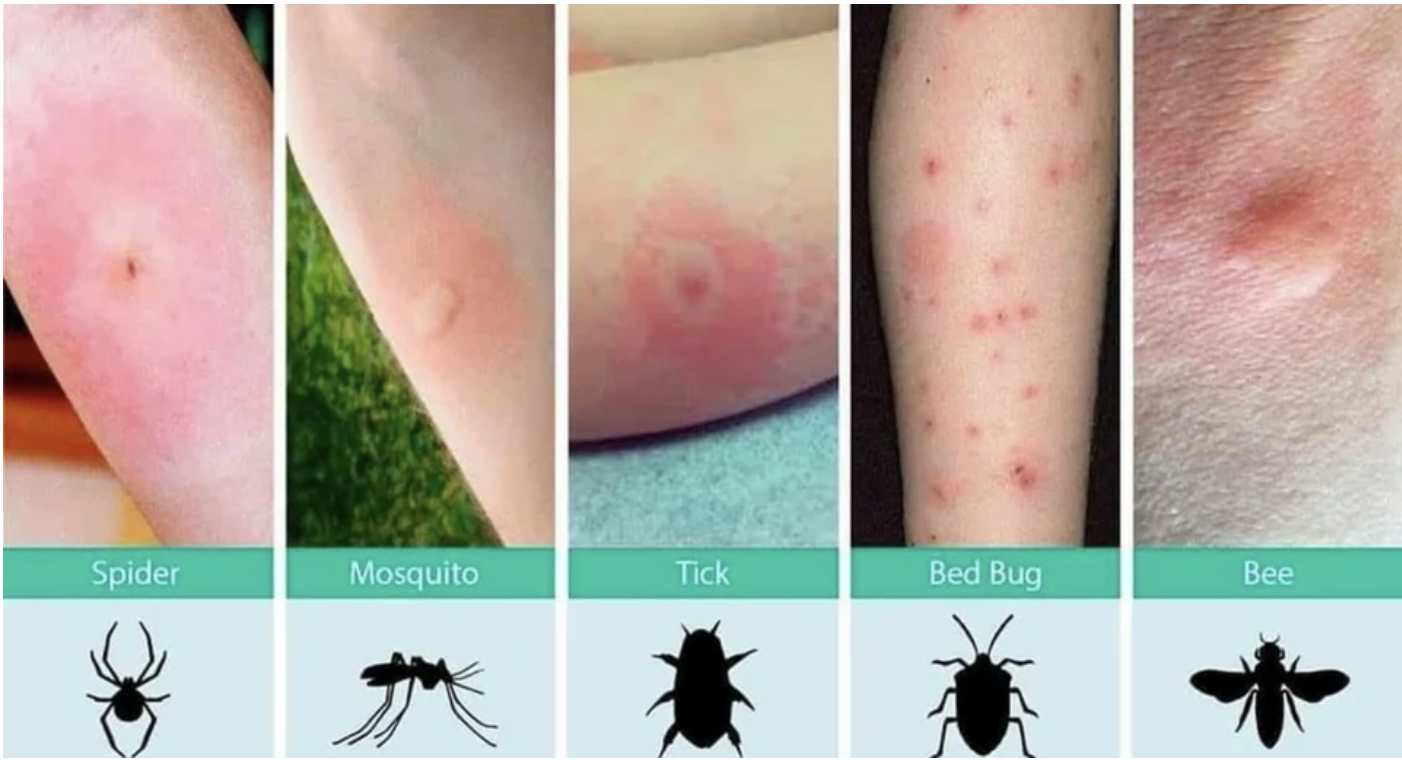 Photos of different bites on a child&#x27;s arm: spider, mosquito, tick, bedbug, and bee