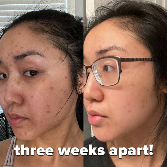 reviewers skin before and after using snail mucin serum with less dark spots