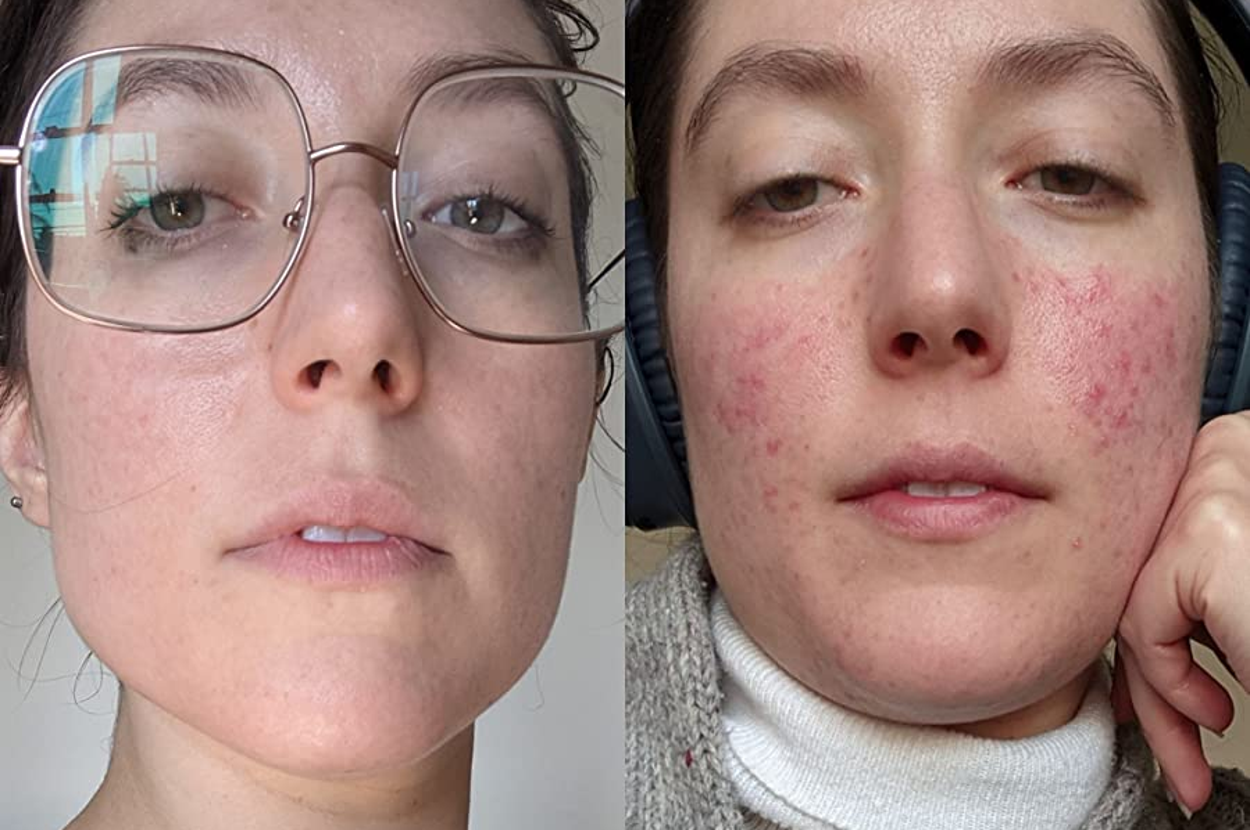 reviewer before and after photos, showing their skin with acne on the right and their skin looking much clearer after using the cleanser on the left