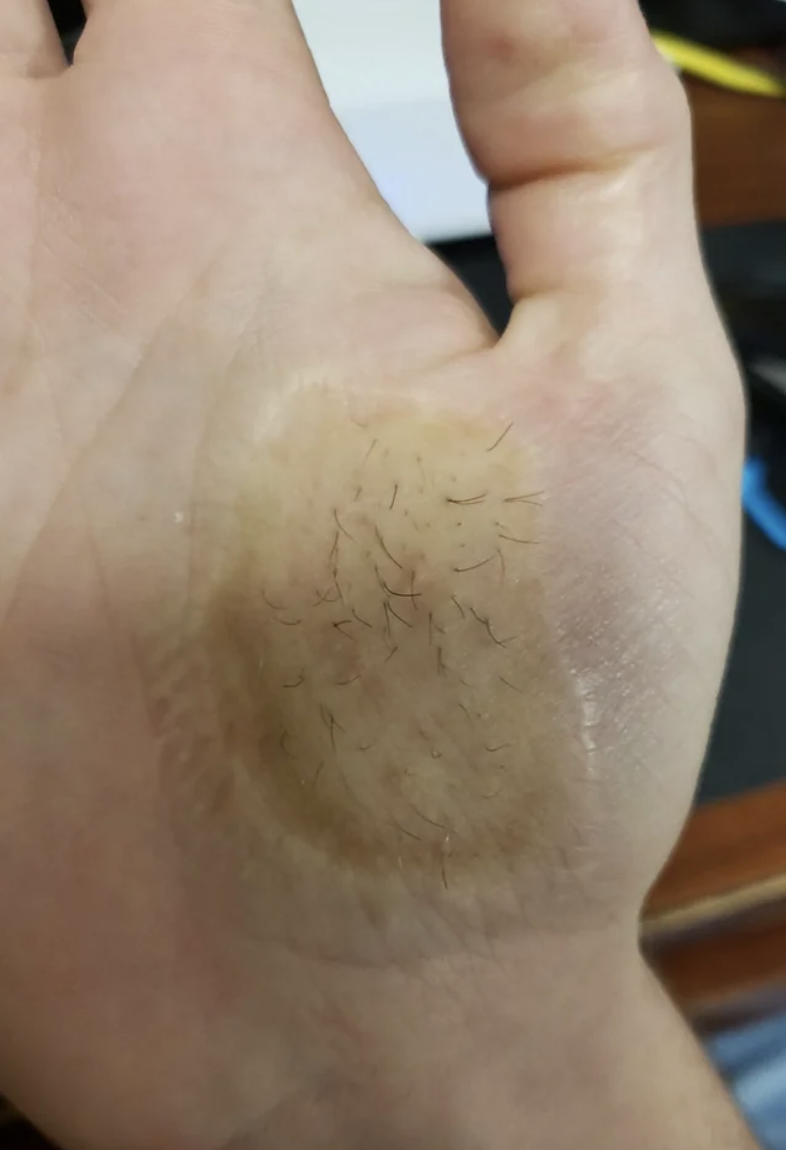 hairy patch on a hand
