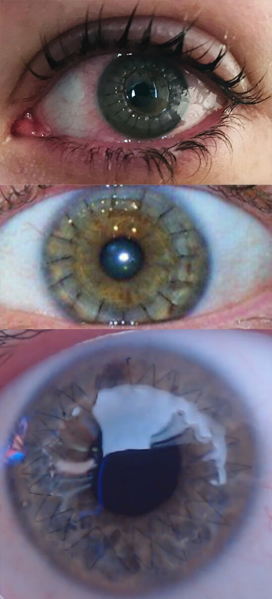 closeup of the stitches seen in the eye