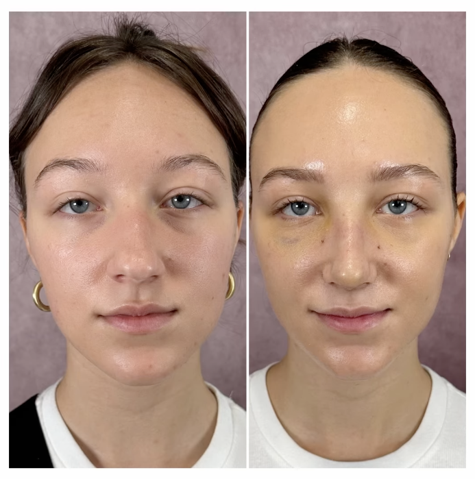 before and after pics of her nose, with a very subtle difference