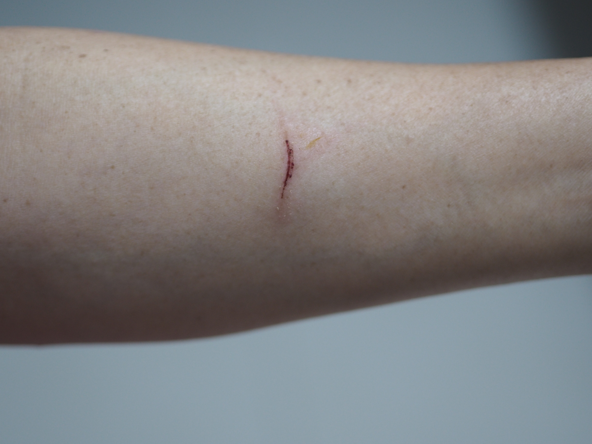Close-up of a scratch on an arm