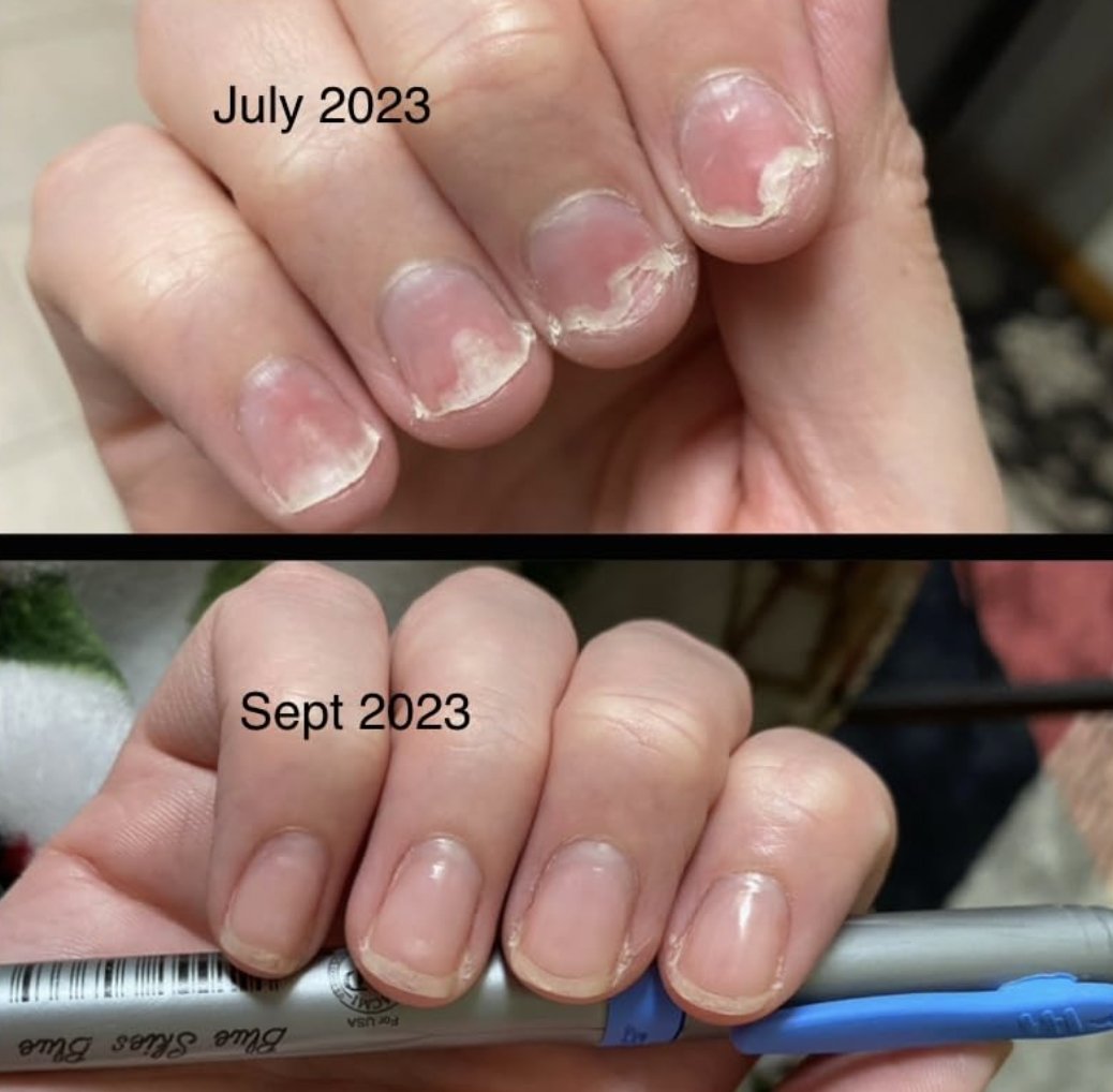 reviewer photo showing their impressive nail growth using the treatment from July to September