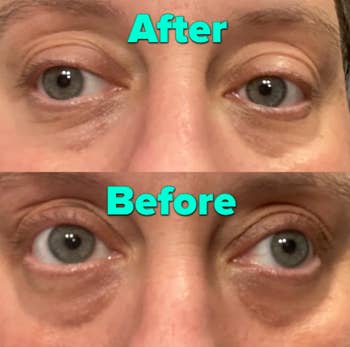 reviewer before and after of dark under eyes before using eye patches and after using with dark circles much lighter