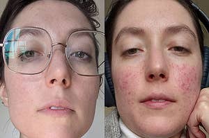 reviewer before and after photos, showing their skin with acne on the right and their skin looking much clearer after using the cleanser on the left