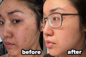 before/after of reviewer's dull acne prone skin looking brighter and clearer
