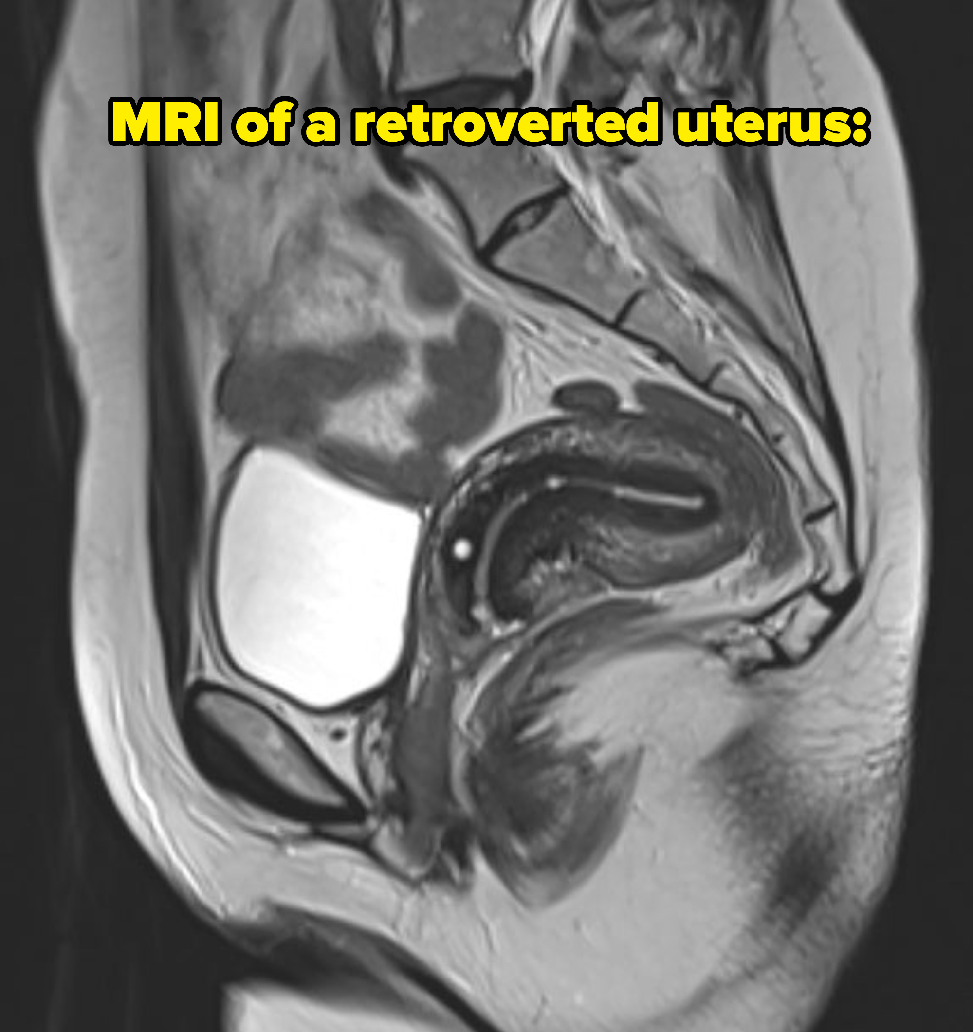 An MRI of a retroverted uterus