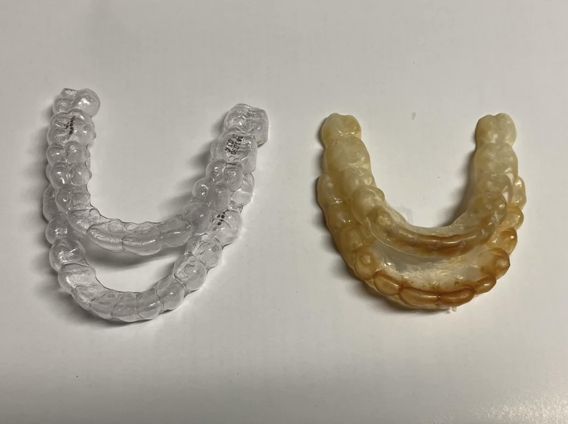The old teeth retainer is a dirty beige, next to the clean, clear set