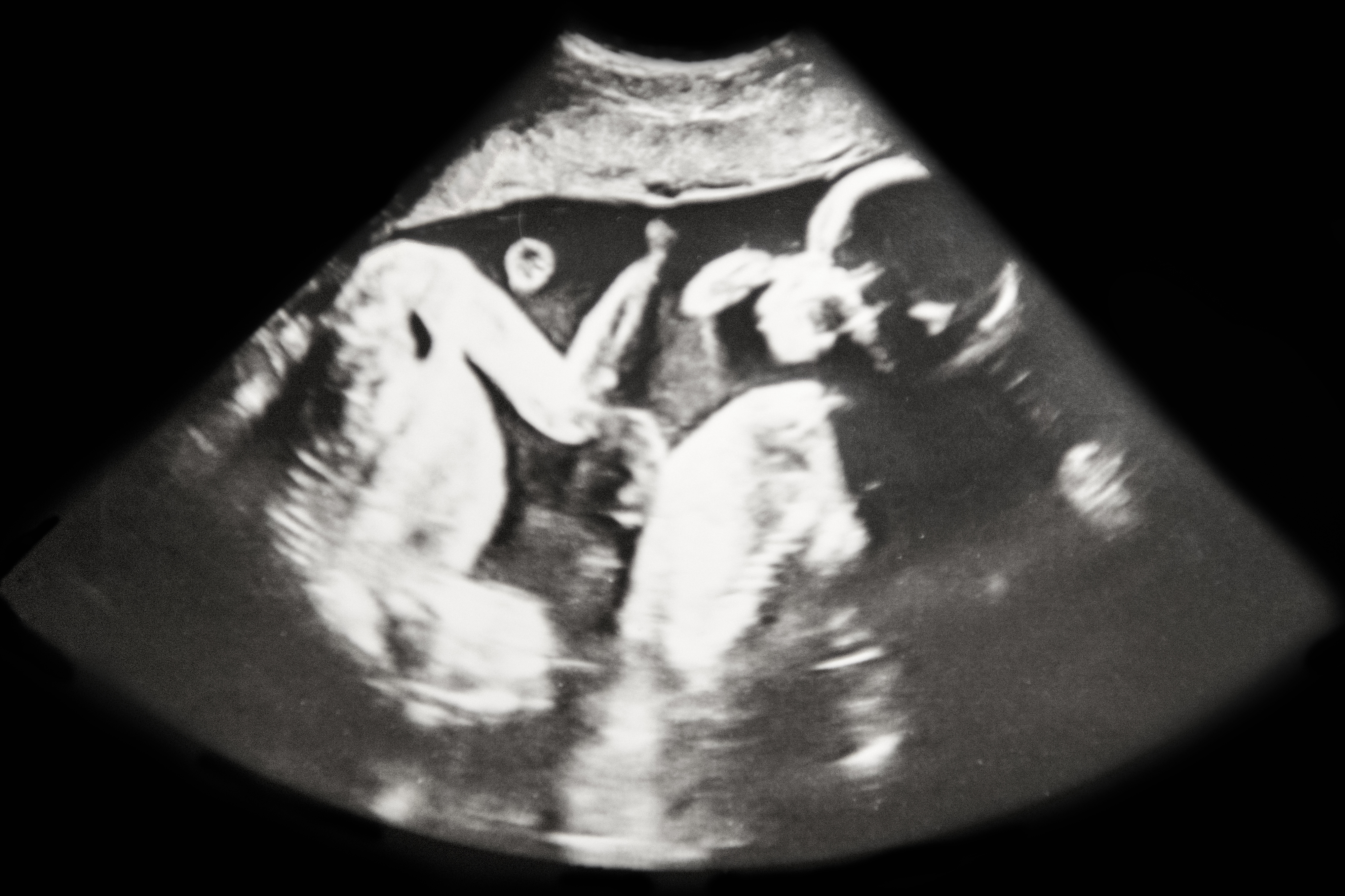 ultrasound showing two babies in the womb