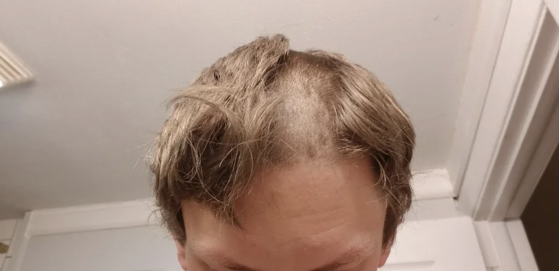 person with longer hair now has a buzzcut down the middle