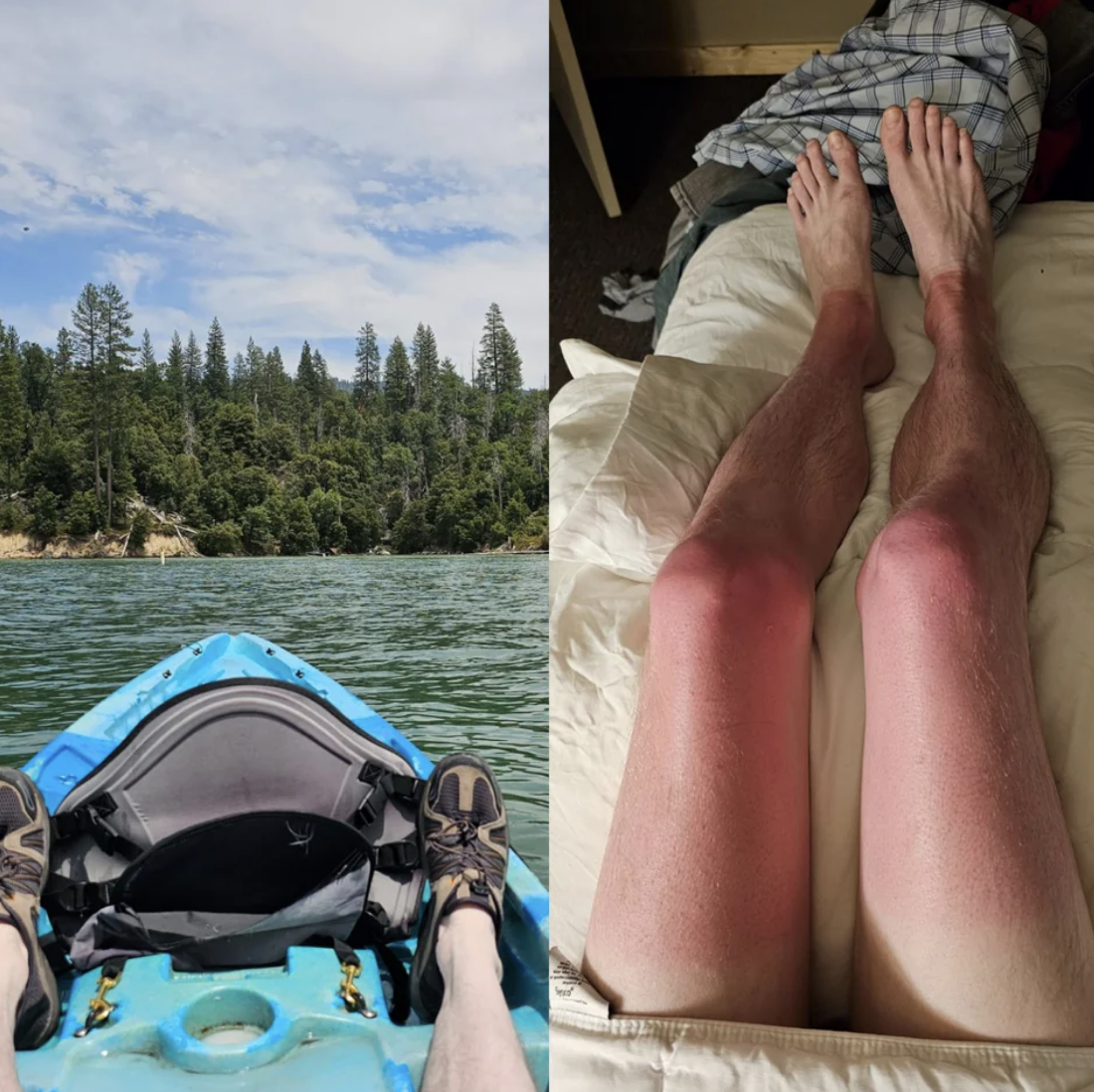 burned legs with tan lines at the feet