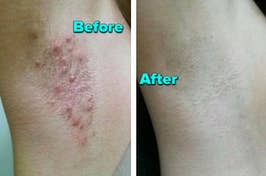 reviewers armpit with razor burn before using Tend solution and then bumps gone in after picture
