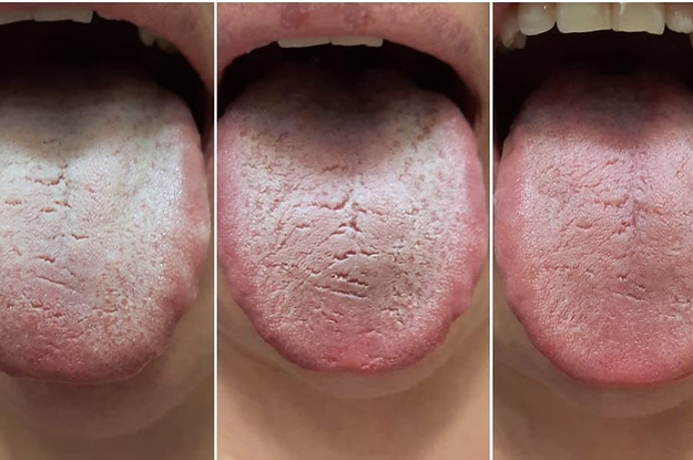 reviewer showing three progression photos: tongue first thing in the morning with white film, then after brushing with toothbrush looking slightly better, then after using scraper with the tongue looking significantly better with no film