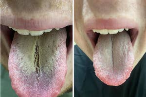 A reviewer with a dirty tongue/The same tongue cleaner after using a scraper 