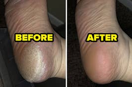 before and after images of a reviewer's foot that goes from being covered in thick callused skin to being completely smooth