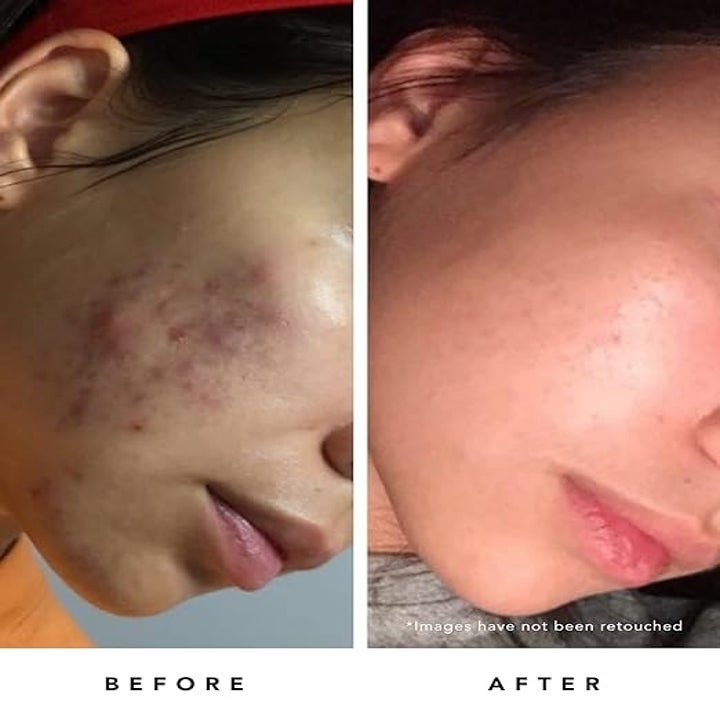 before photo with acne and after photo with clearer skin and less acne