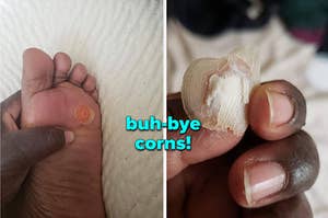reviewers foot with a corn on it and same reviewer holding their corn that fell off using corn removing pads