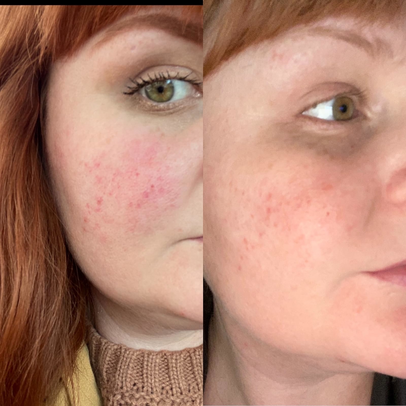 Reviewer before with red skin and after with less blemishes and redness