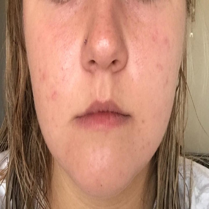 Reviewer's face with less redness after using the cream