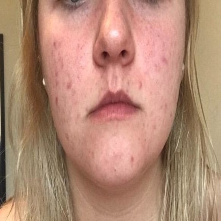 Reviewer before using the cream