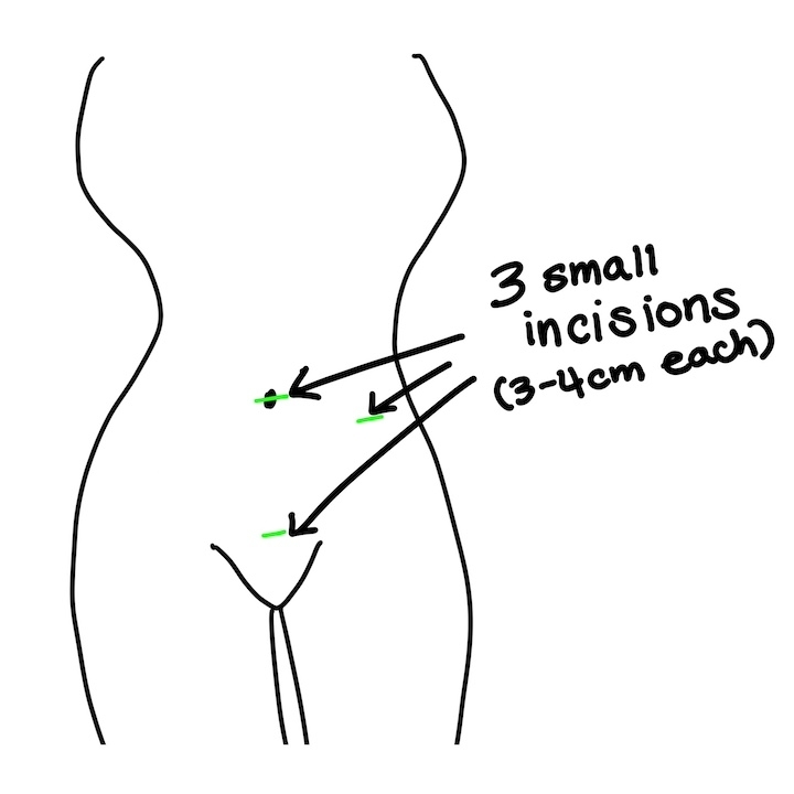 diagram of where the incisions were made
