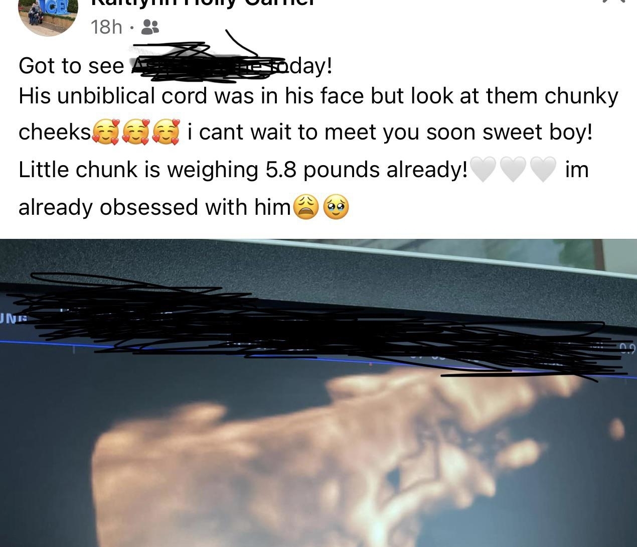 &quot;His unbiblical cord was in his face but look at them chunky cheeks! I can&#x27;t wait to meet you soon sweet boy! Little chunk is weighing 5.8 pounds already! I&#x27;m already obsessed with him&quot;
