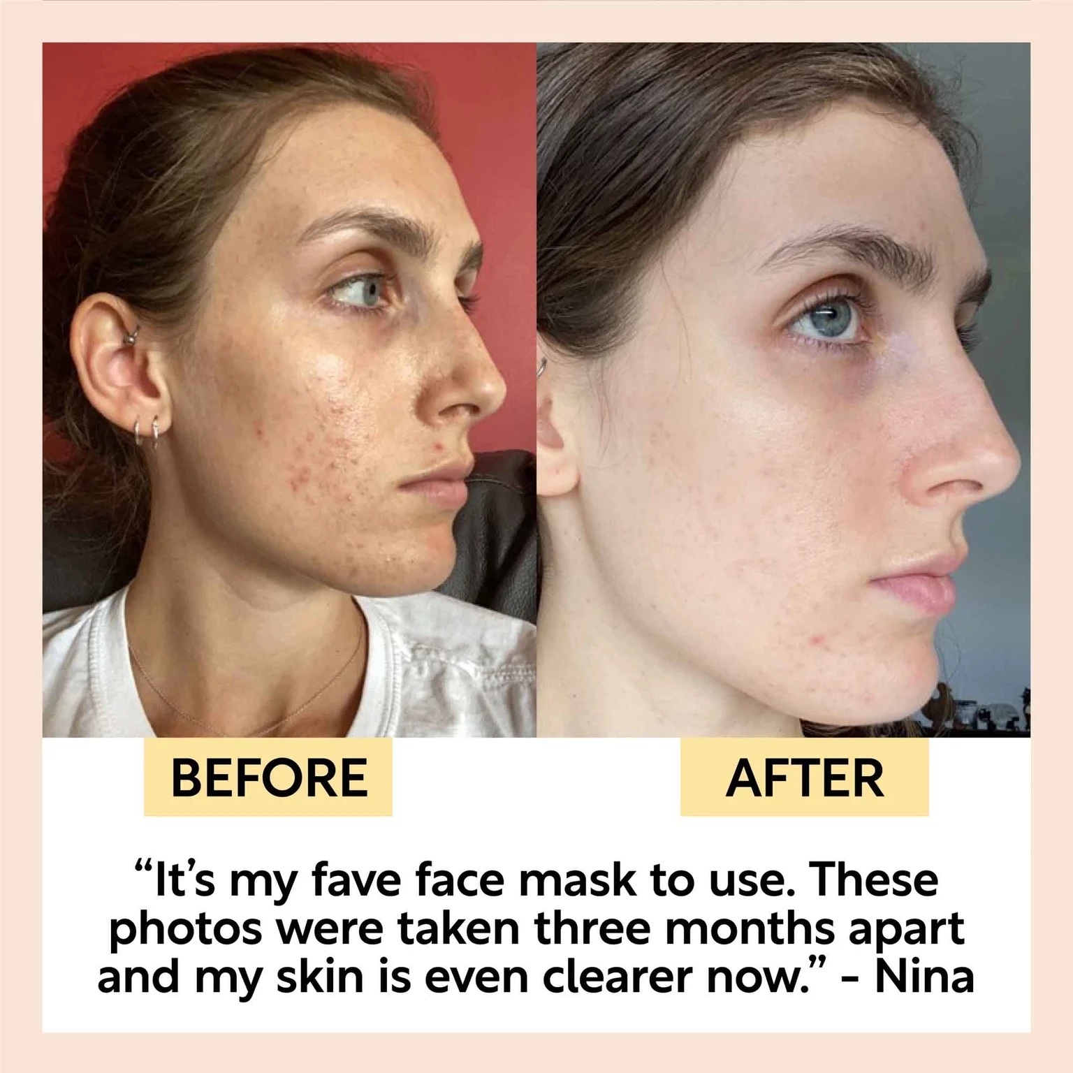 a before and after of a reviewer getting clearer skin from the mask, captioned &quot;it&#x27;s my fave face mask to use. these photos were taken three months apart and my skin is even clearer now, Nina&quot;