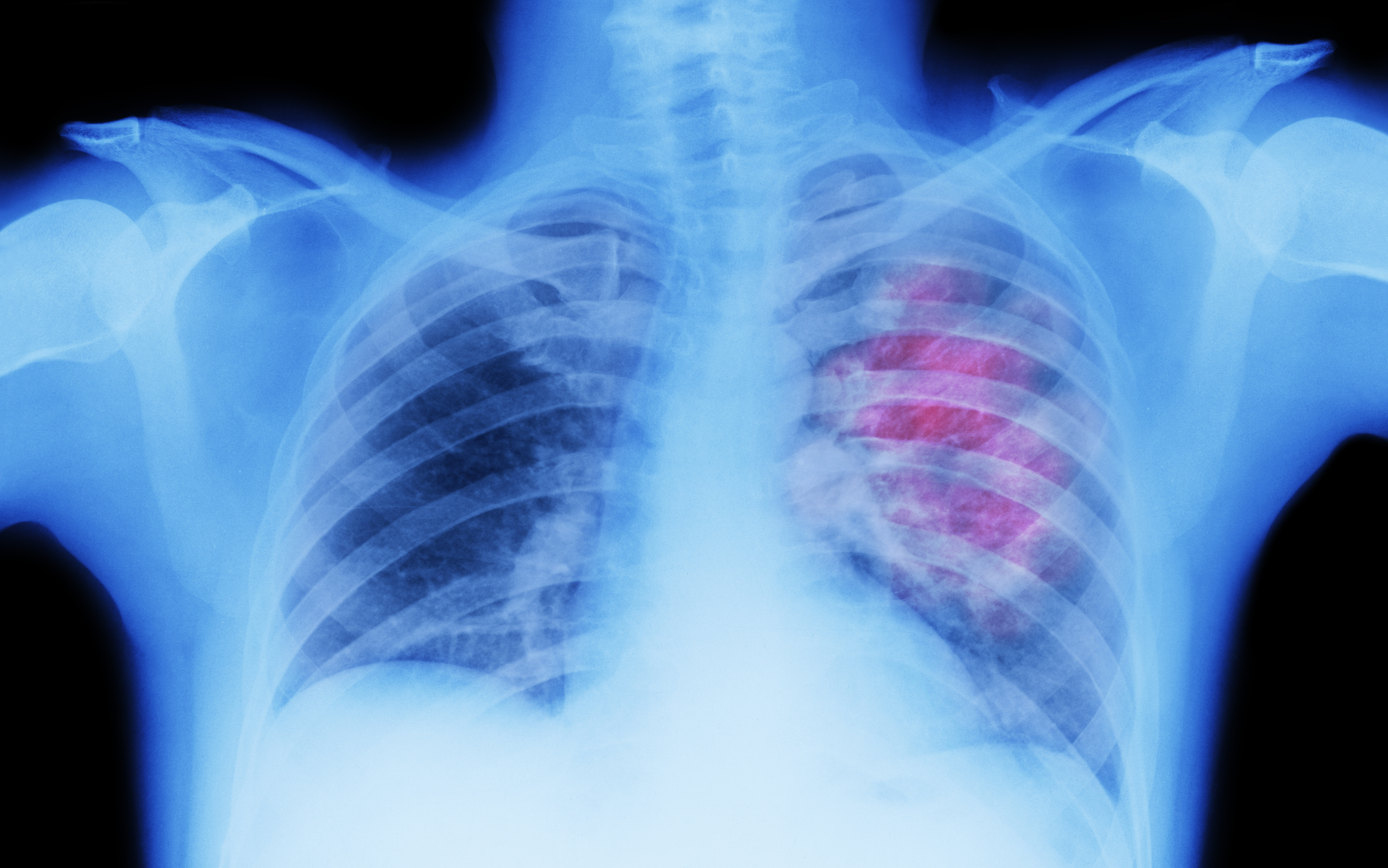 An X-ray with a red area indicating cancer