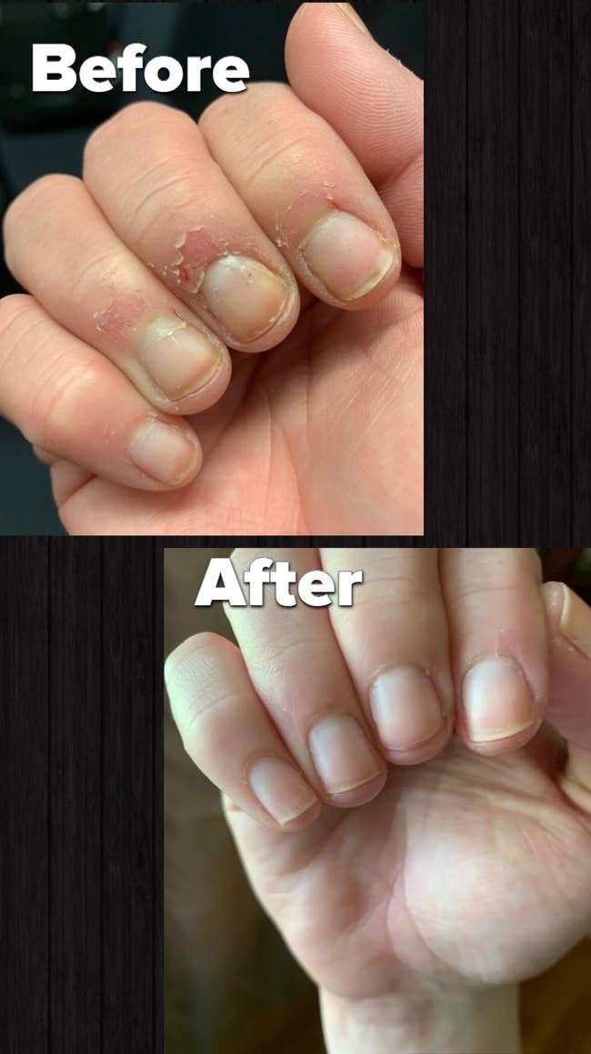 reviewers damaged cuticles and nails before using oil then healed after