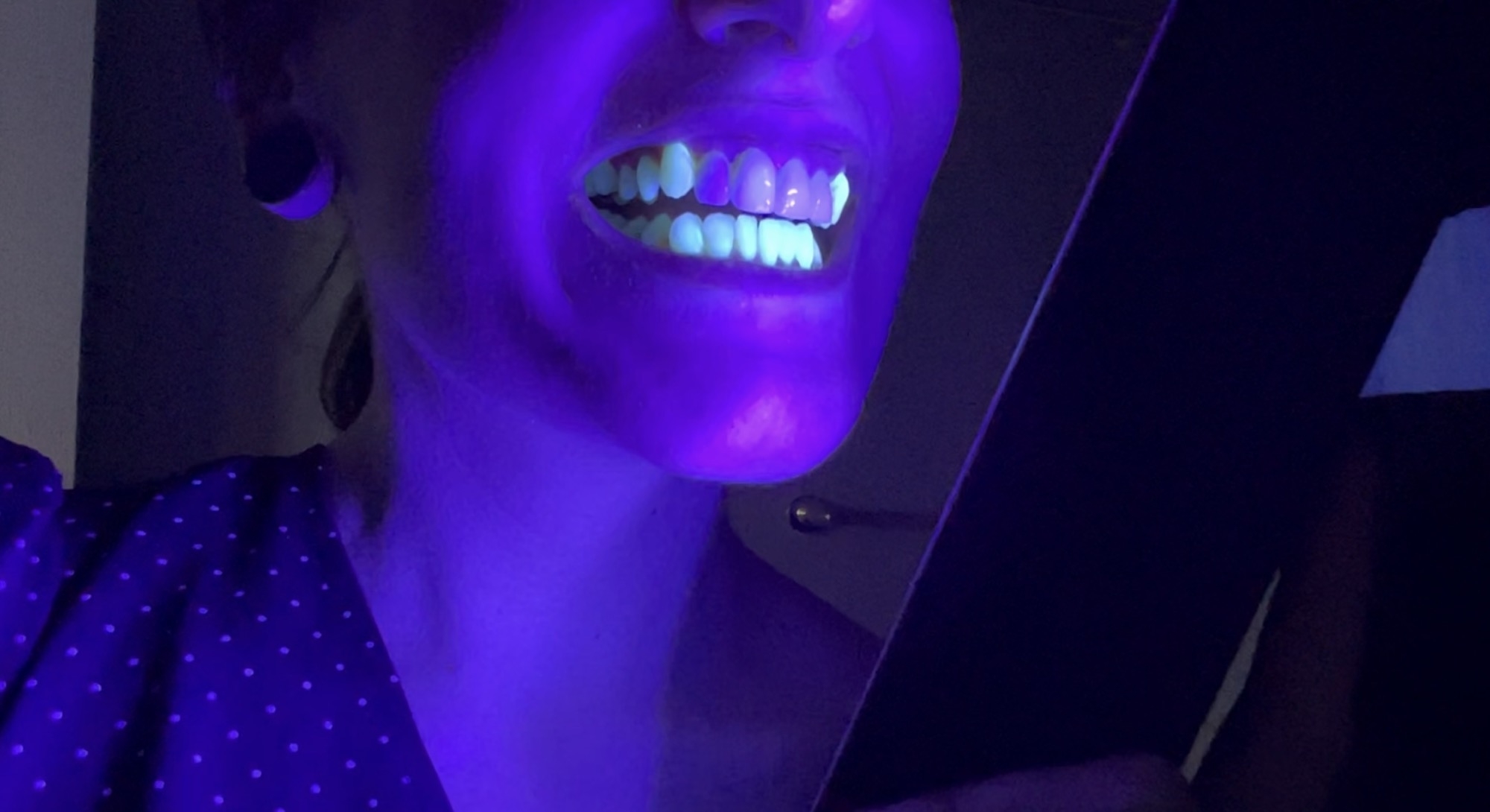 A smiling person&#x27;s teeth glowing in the dark except for four front teeth