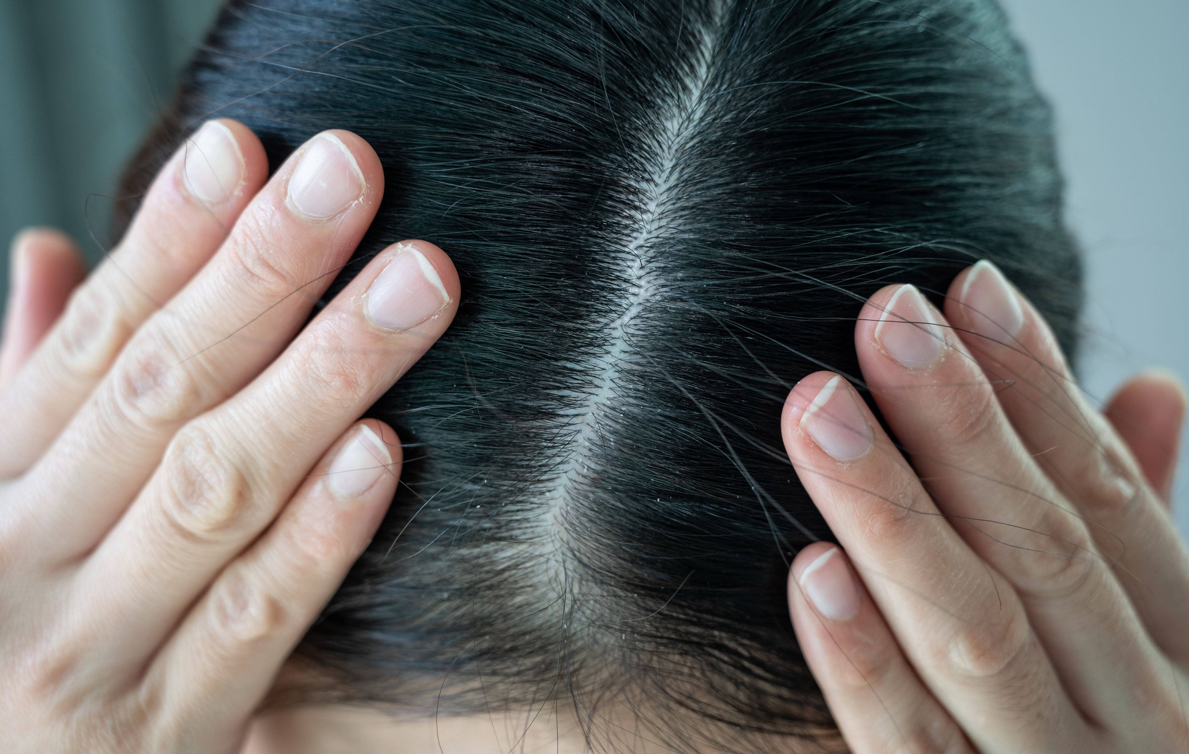 up-close of a person&#x27;s scalp